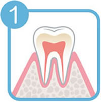 歯周病の進行レベル