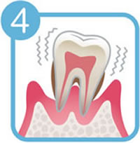 歯周病の進行レベル